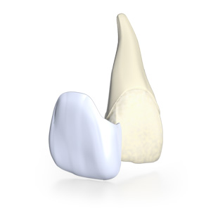 Inlays und Veneers